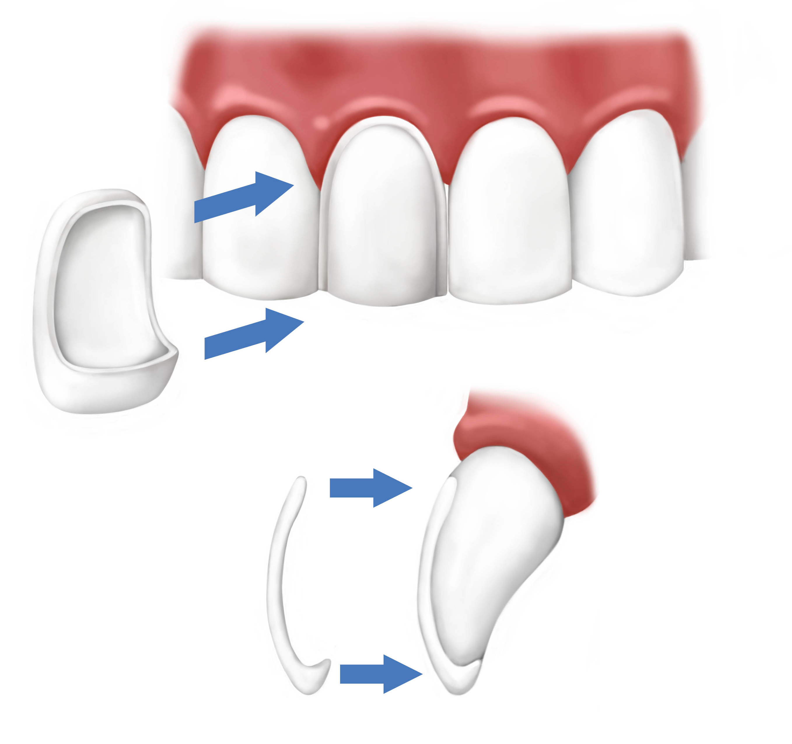 Porcelain Veneers in Buffalo, NY - Dental Veneers & Lumineers in WNY